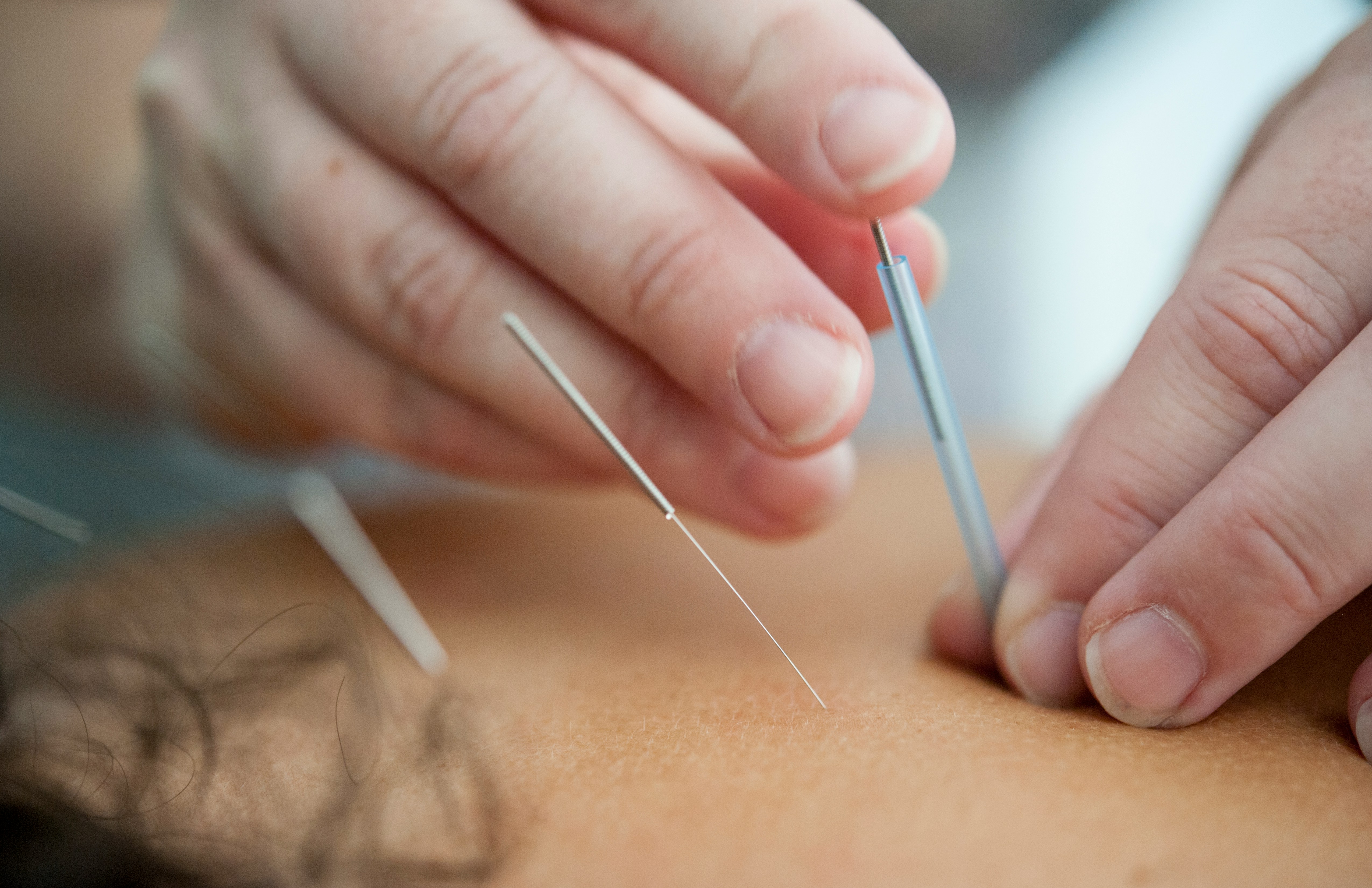 Acupuncturist treating a client